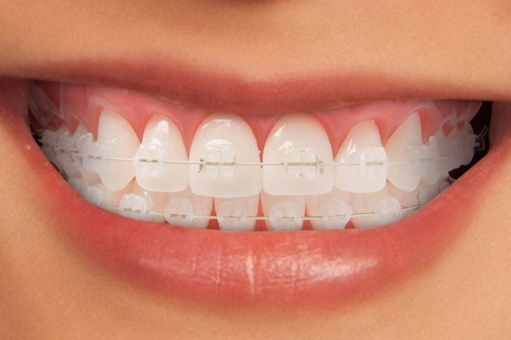 براکت شفاف در ارتودنسی؛ فناوری و کاربرد در تقویم دندان‌ها