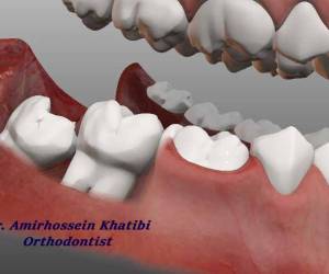 ارتودنسی و ارتباط آن با دندان عقل