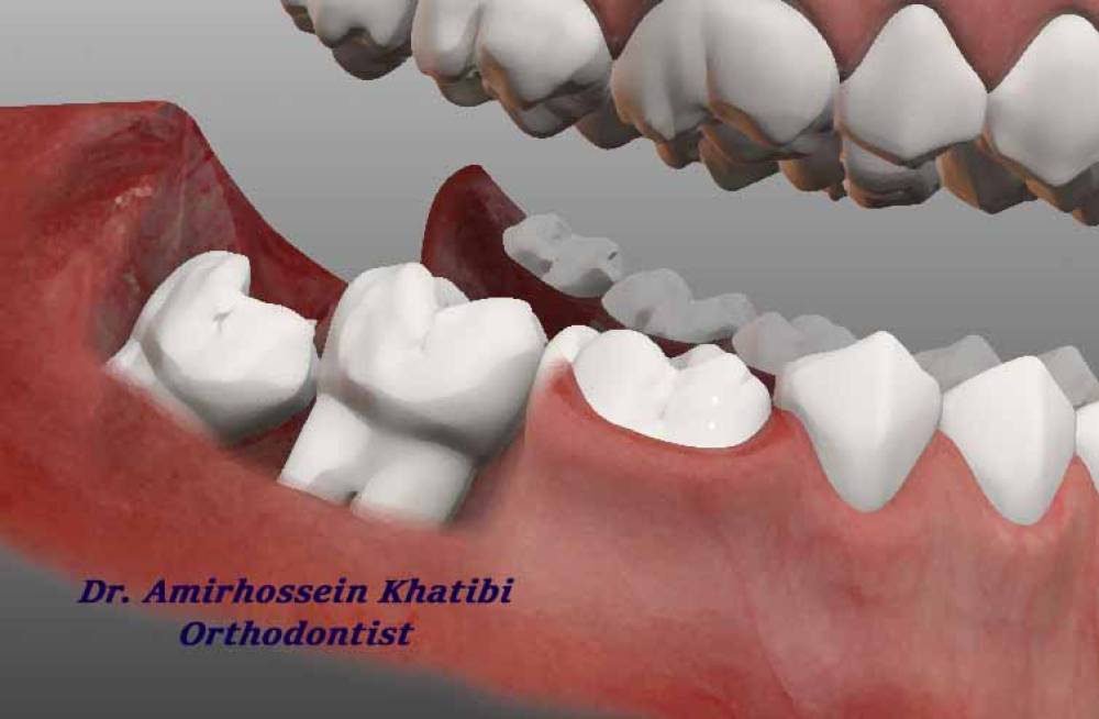 ارتودنسی و ارتباط آن با دندان عقل